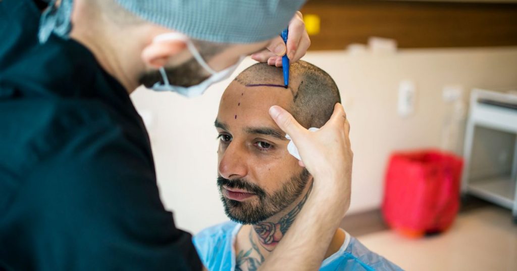 Hair transplant cost