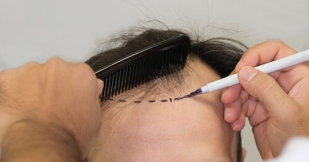 Hair transplant cost